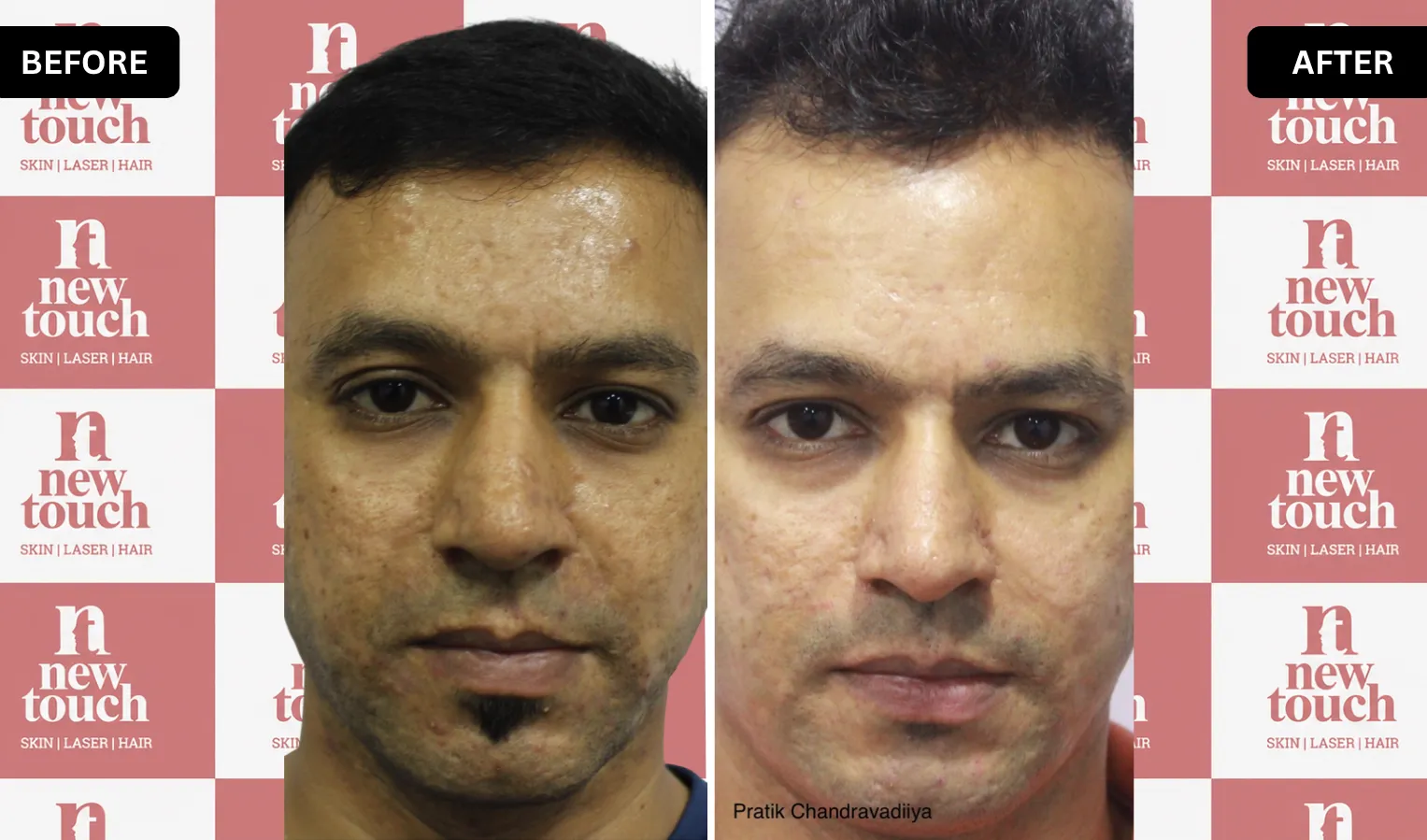 Treatment Result