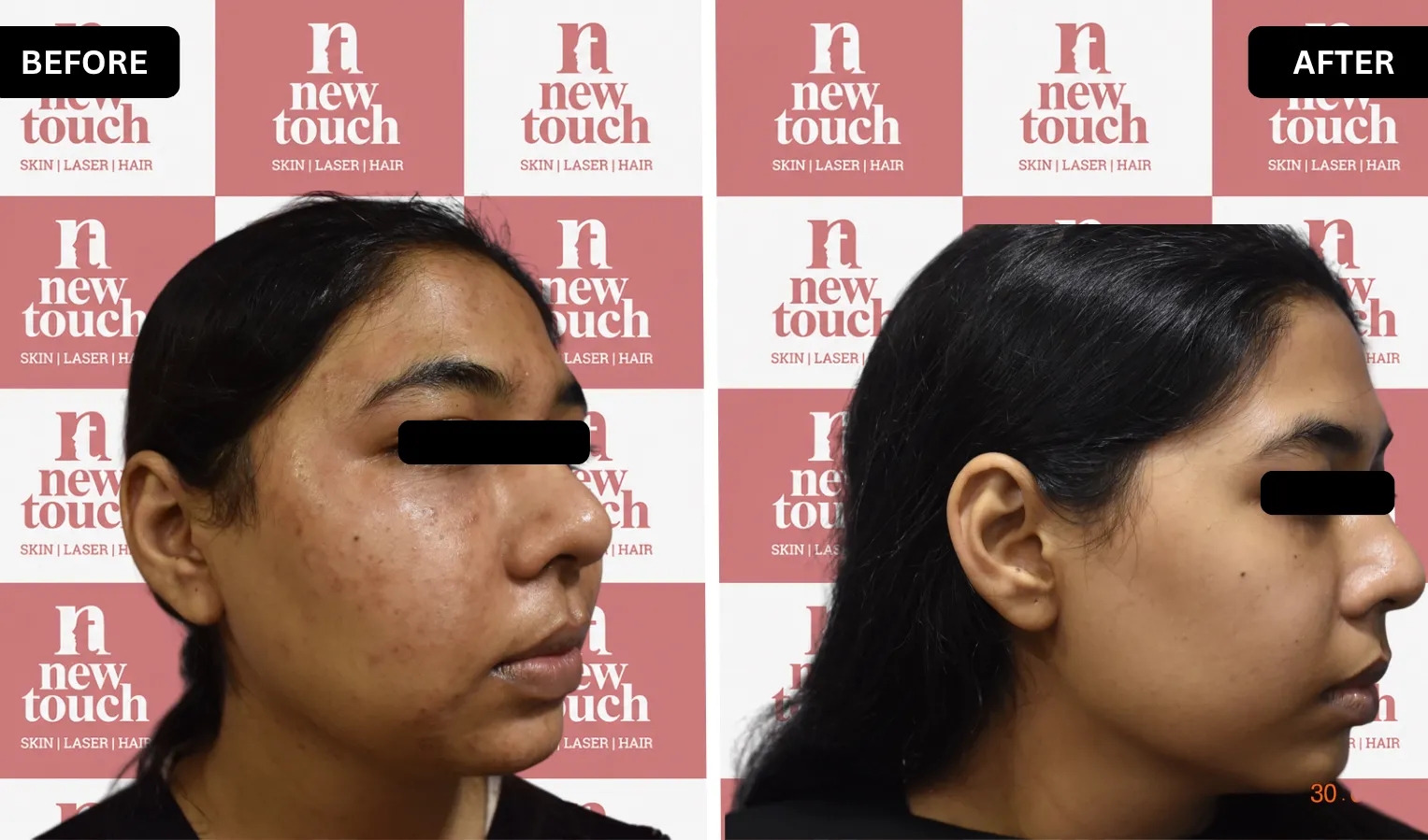 Treatment Result