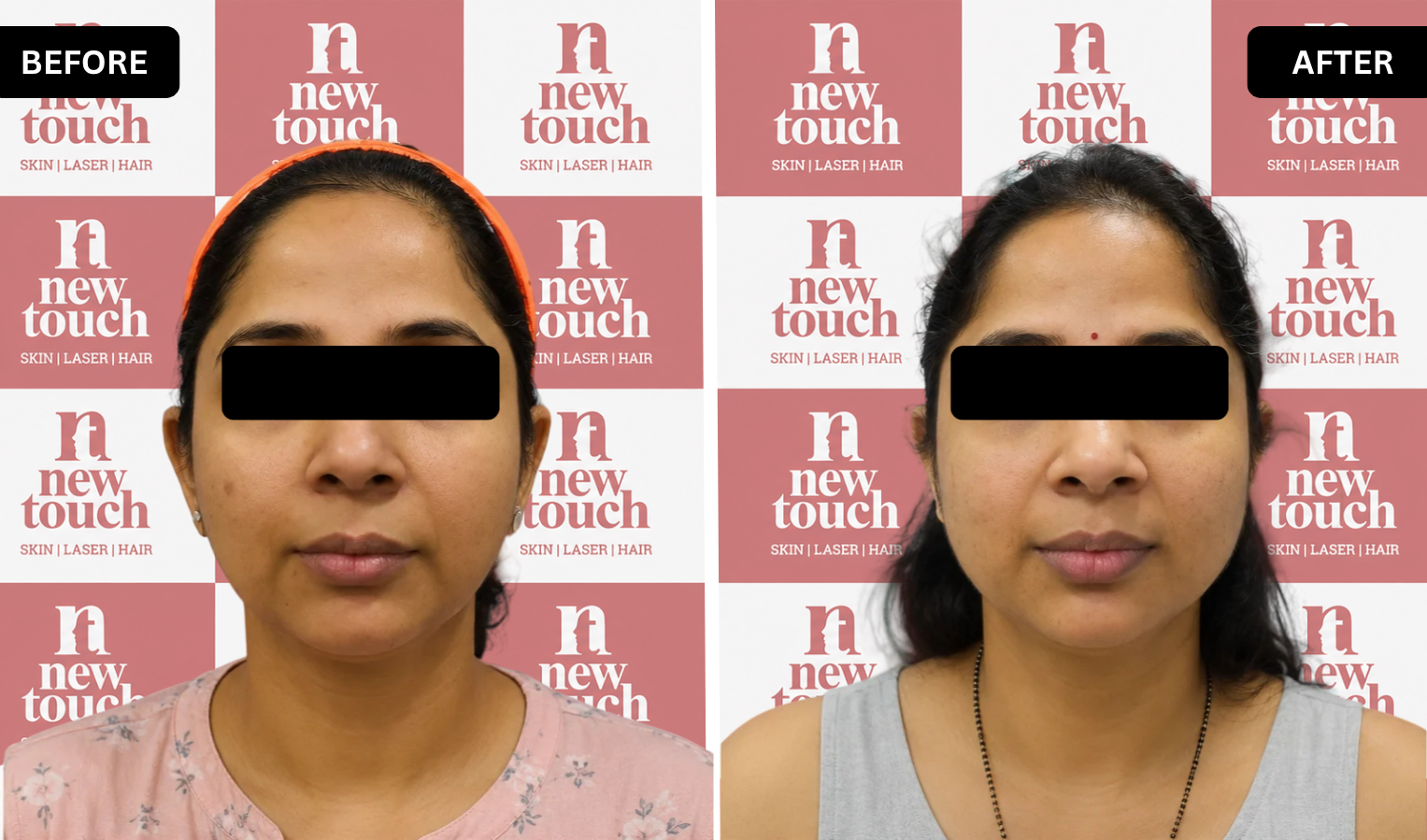 Before and after treatment