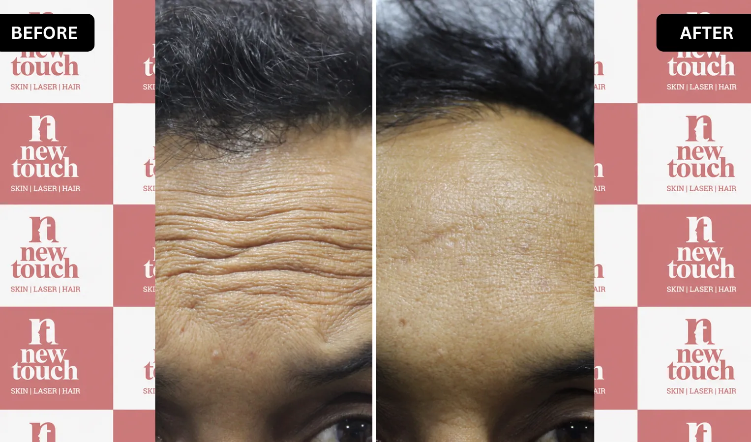 Before and after treatment