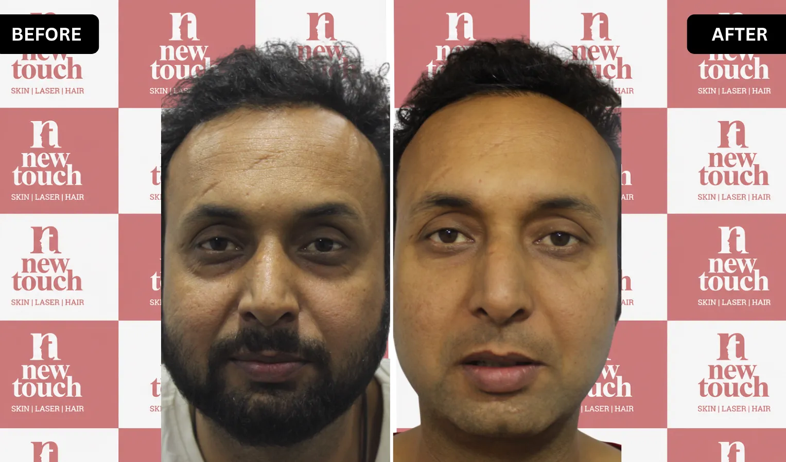 Before and after treatment