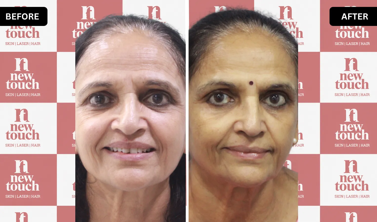 Before and after treatment