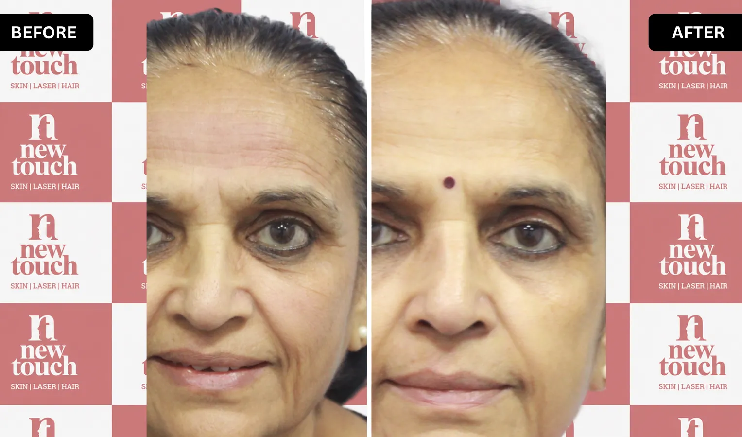 Before and after treatment