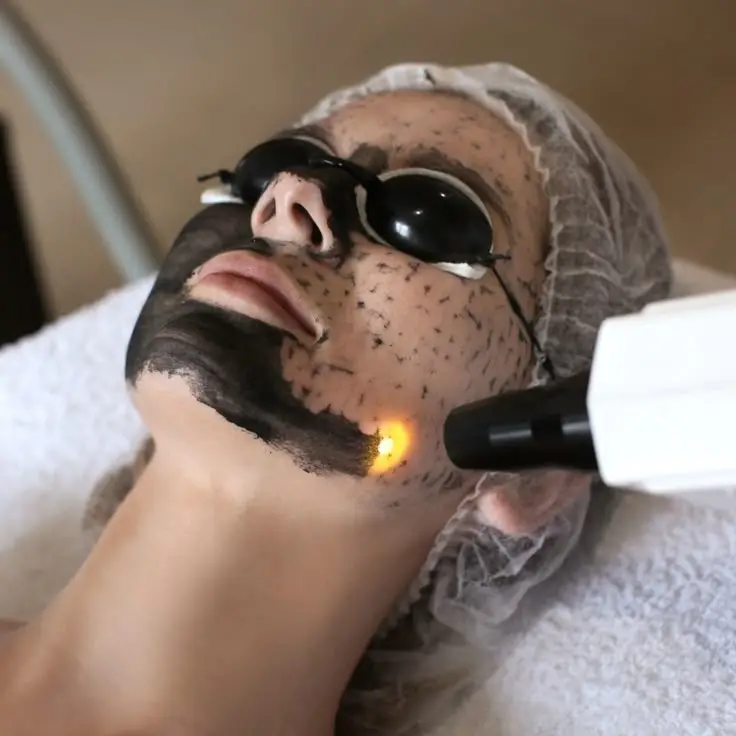 Carbon Laser Peel Treatment
