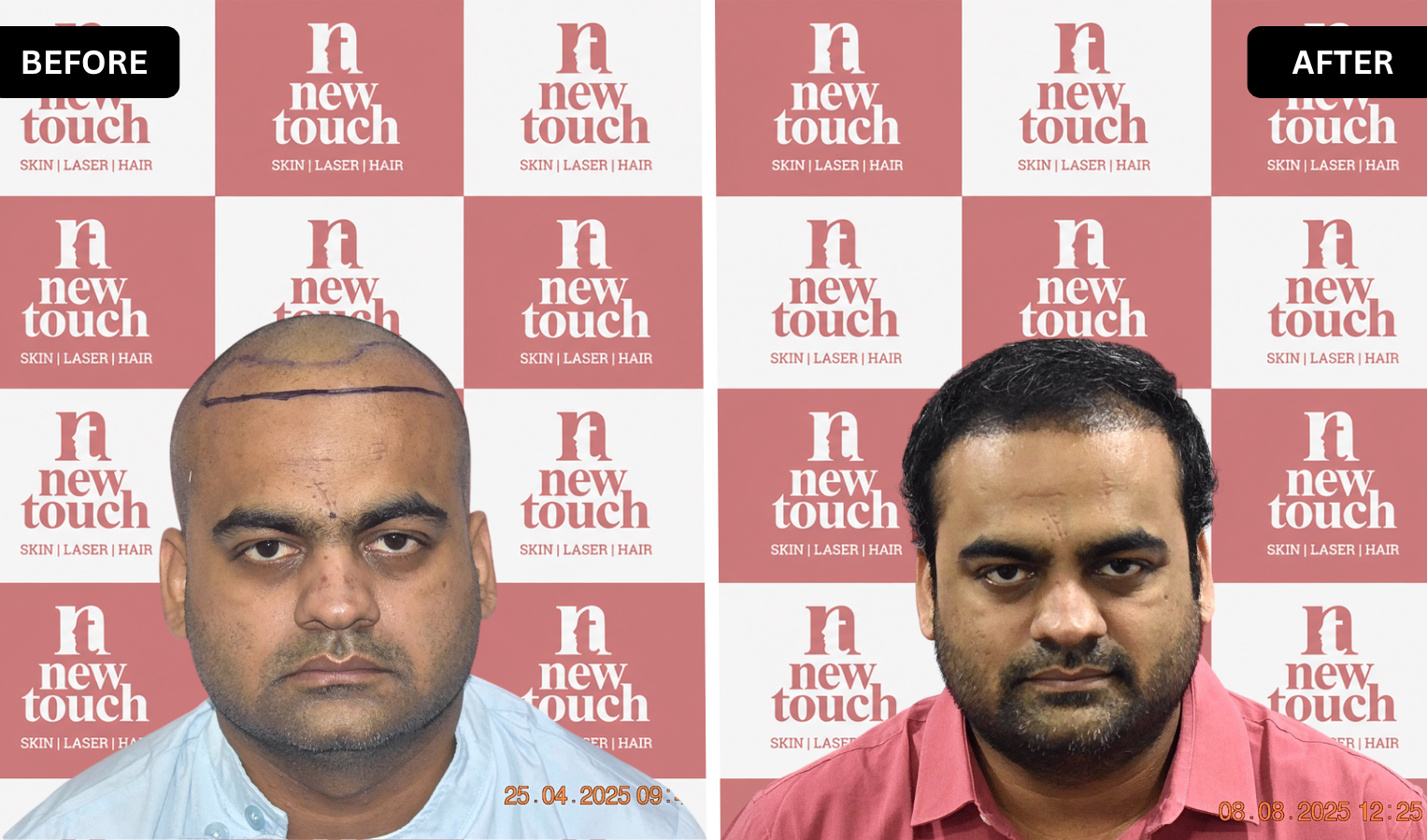 Treatment Result