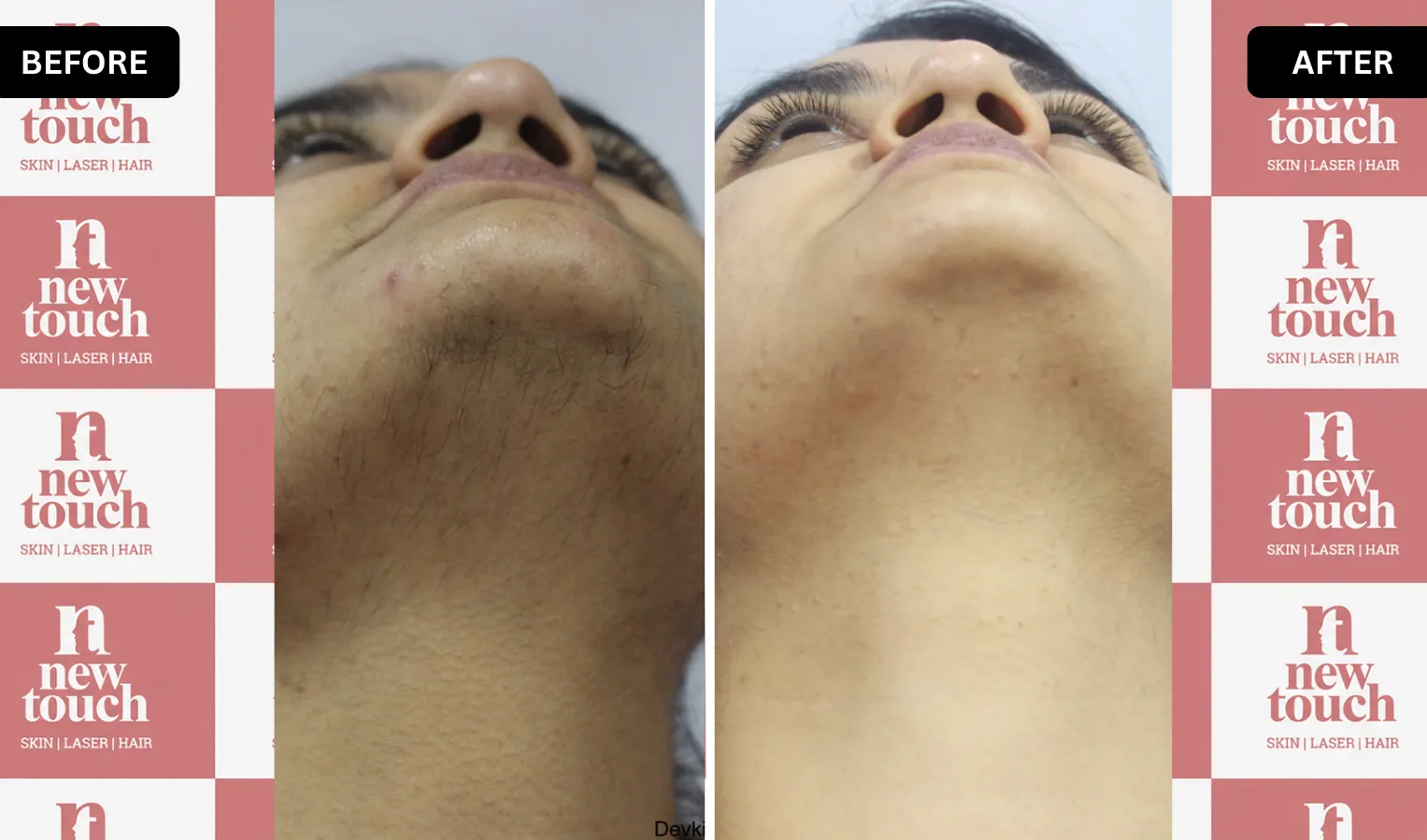 Treatment Result