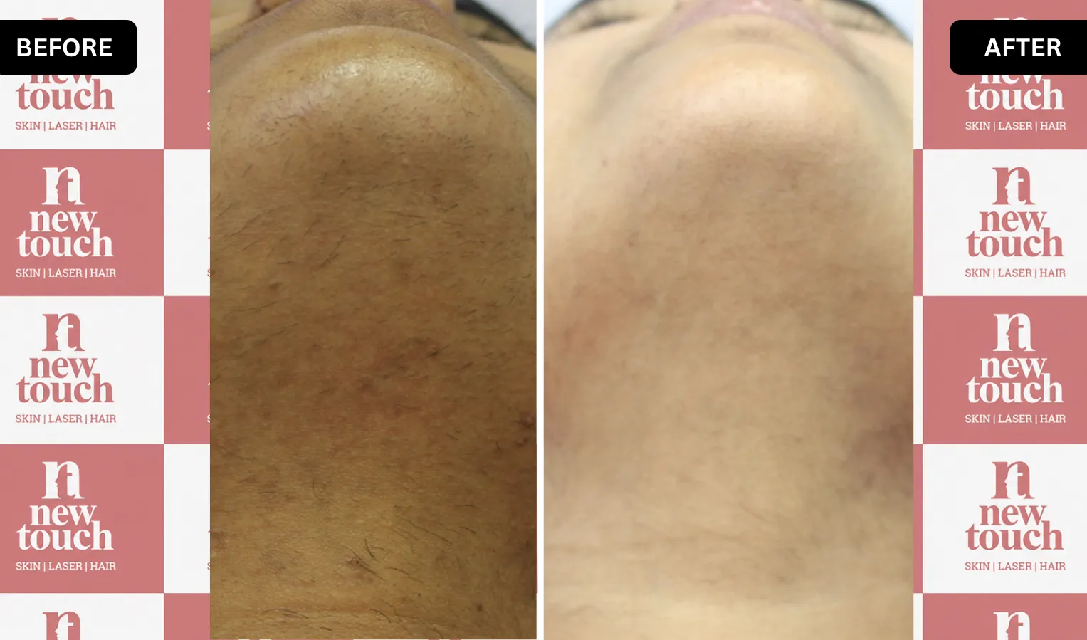 Treatment Result