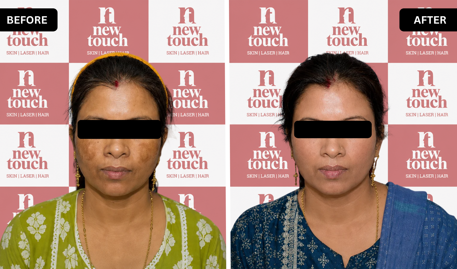 Before and after treatment