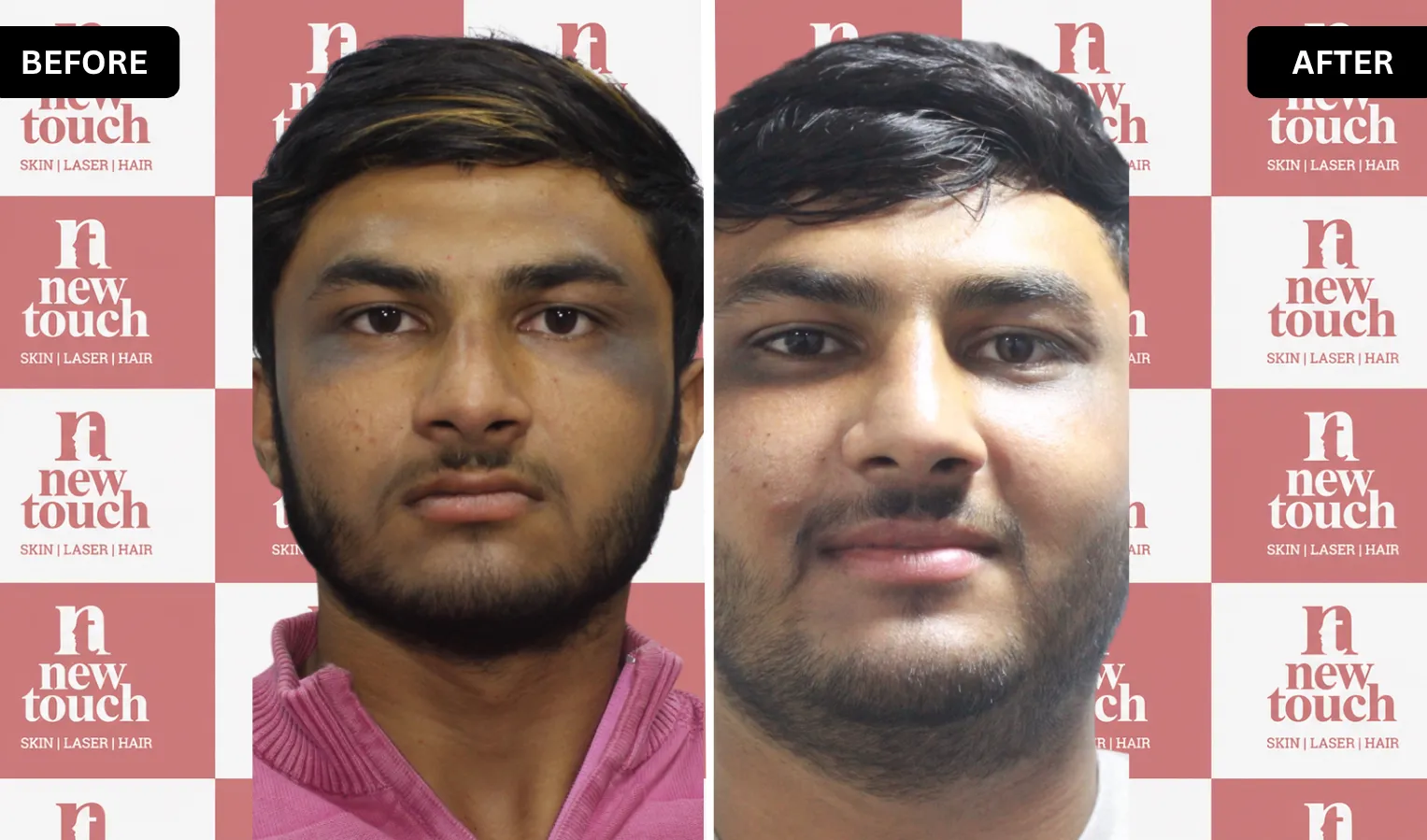 Treatment Result