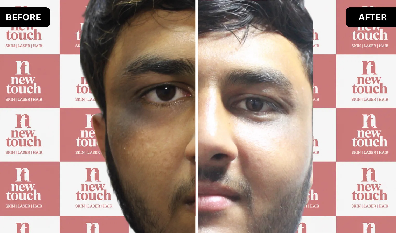 Treatment Result