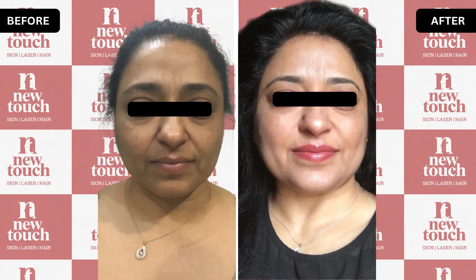 Treatment Result