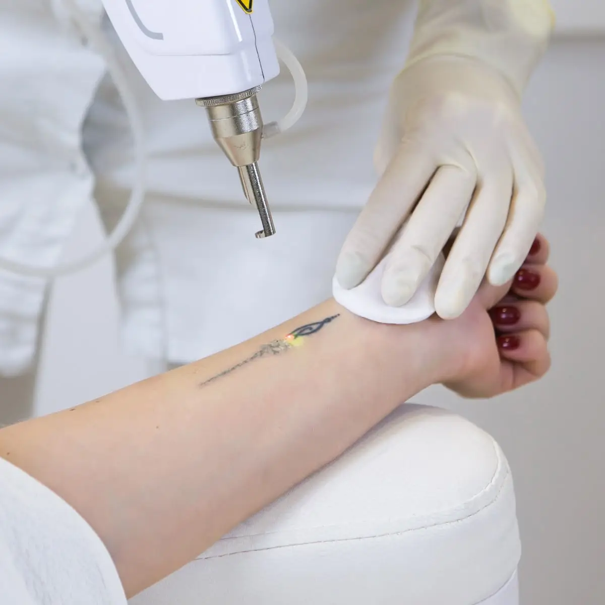 New Touch Laser Tattoo Removal