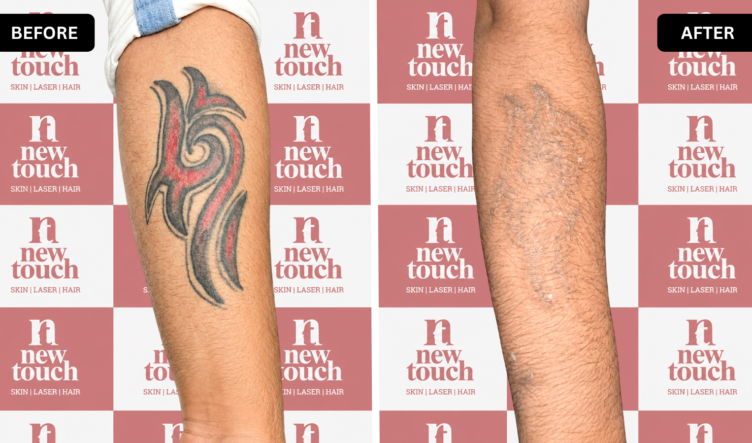 Before and after treatment